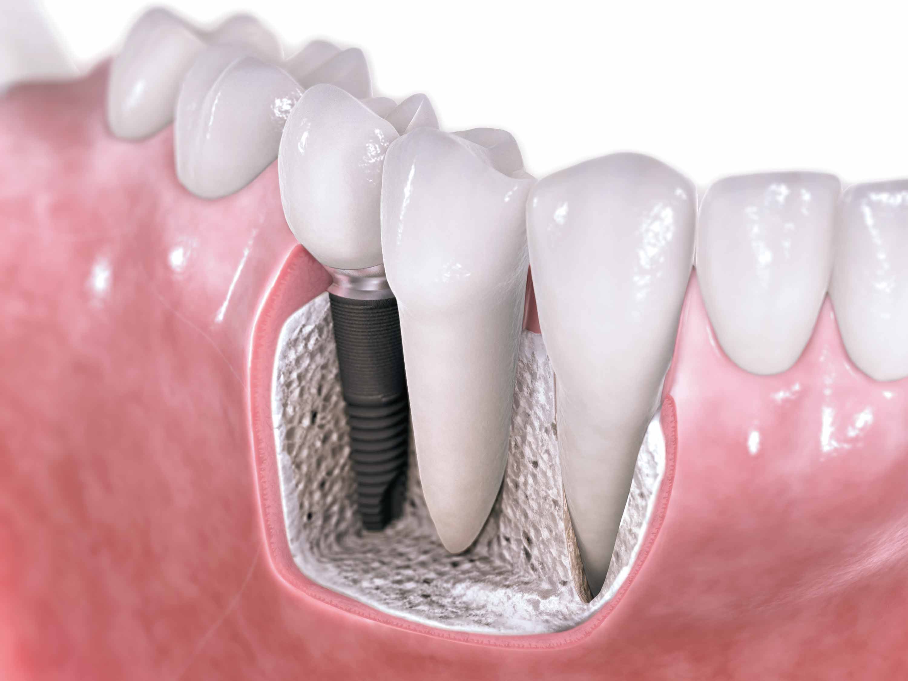 Hex-Dental-Implantat.jpg